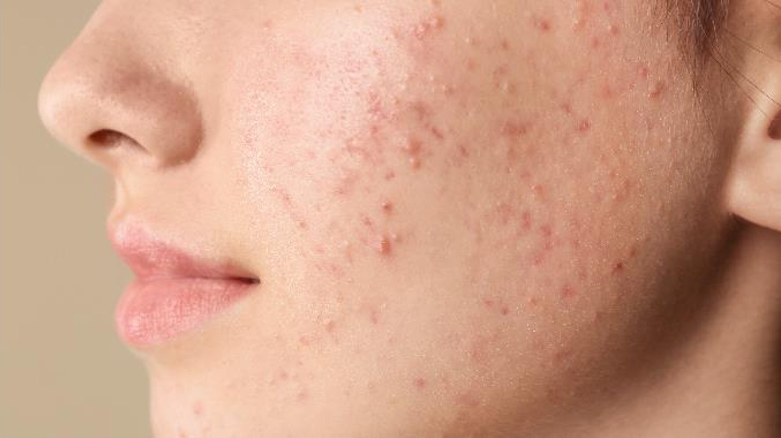Close-up of acne 